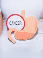 Quick Quiz: Gastric Cancer