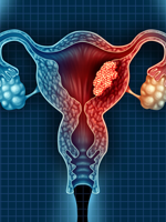 Quick Quiz: Endometrial Cancer
