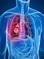 Quick Quiz: Small-Cell Lung Cancer
