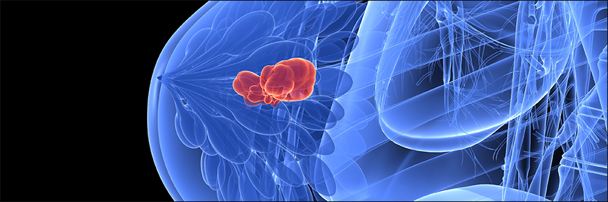 CDK4/CDK6 Inhibitors Show Promise in Advanced Postmenopausal Breast Cancer