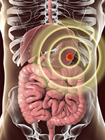 Noteworthy Numbers: Stomach Cancer
