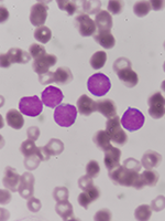 Noteworthy Numbers: Leukemia