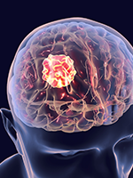 Noteworthy Numbers: Brain Cancer