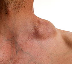 Noteworthy Numbers: Non-Hodgkin Lymphoma