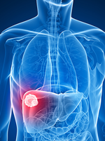 Quick Quiz: Liver Cancer 